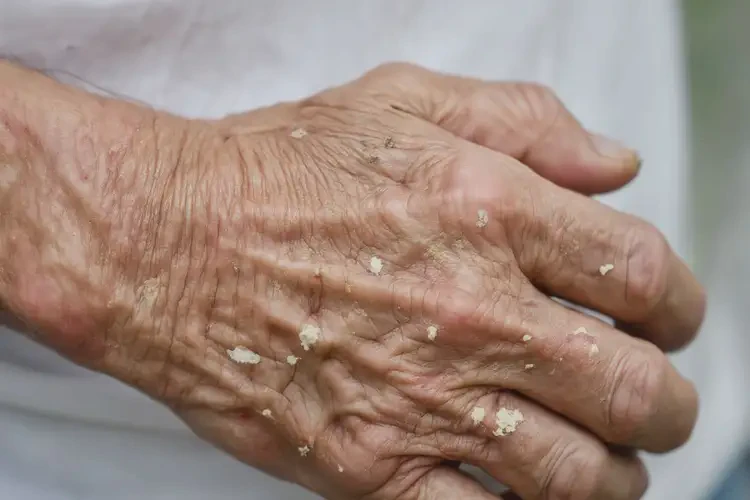 老人手上容易起湿疹不管它会自己自愈吗(图4)