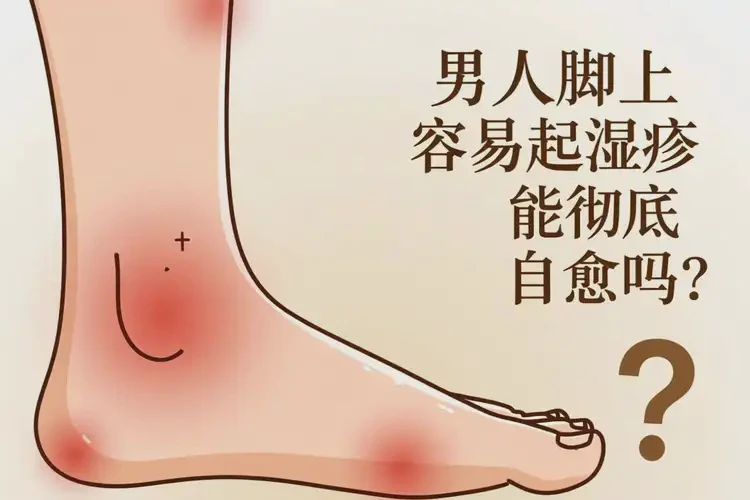 男人腳上容易起濕疹能徹底自愈嗎(圖4)