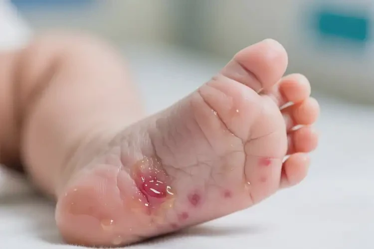 嬰兒腳上經(jīng)常起濕疹可以徹底自愈嗎(圖4)