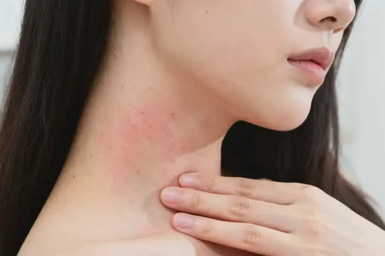 孕婦脖子上經(jīng)常起濕疹能靠自己自愈嗎(圖3)