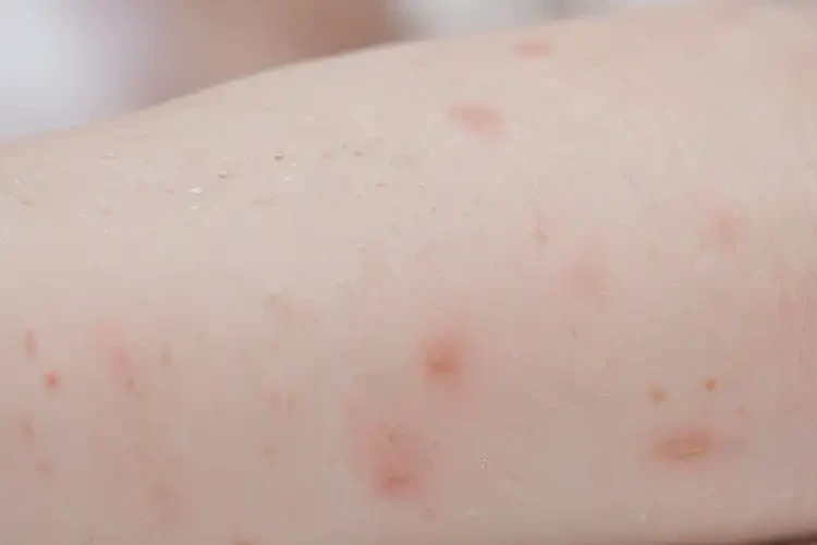 寶寶手臂上出濕疹能徹底自愈嗎(圖4)