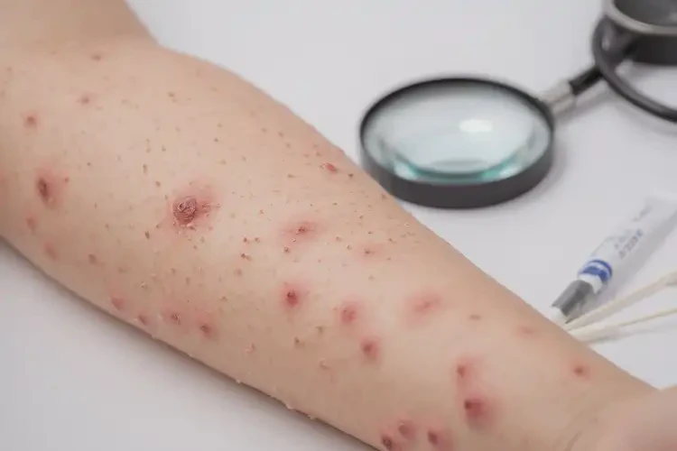 孕婦屁股有濕疹不管它會自己自愈嗎(圖3)