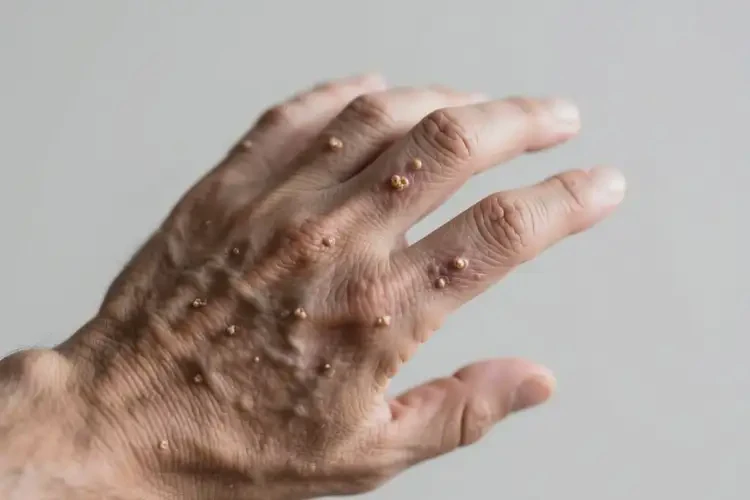 男性手上起濕疹不管它會自己好嗎(圖2)