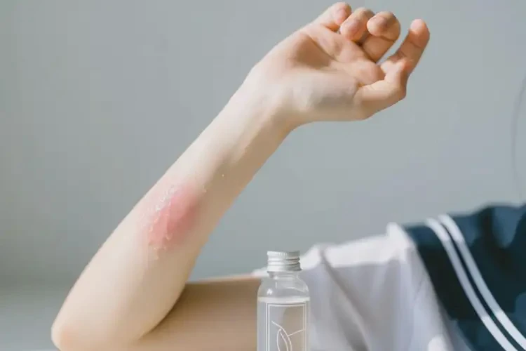 大學(xué)生手臂經(jīng)常起濕疹可以徹底自愈嗎(圖2)