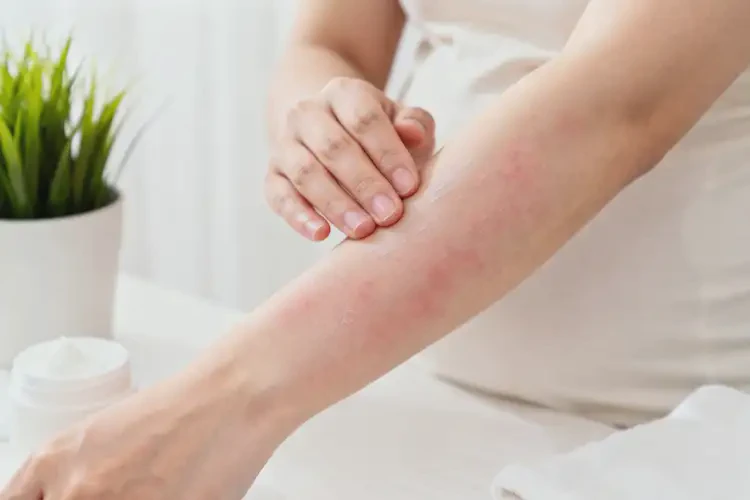 哺乳期媽媽手臂有濕疹能不能徹底自愈(圖4)