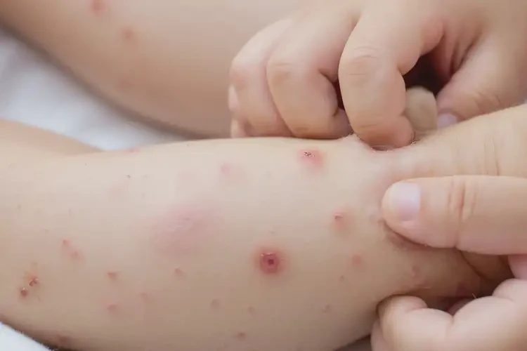 少兒四肢有濕疹不管它會自己痊愈嗎(圖4)