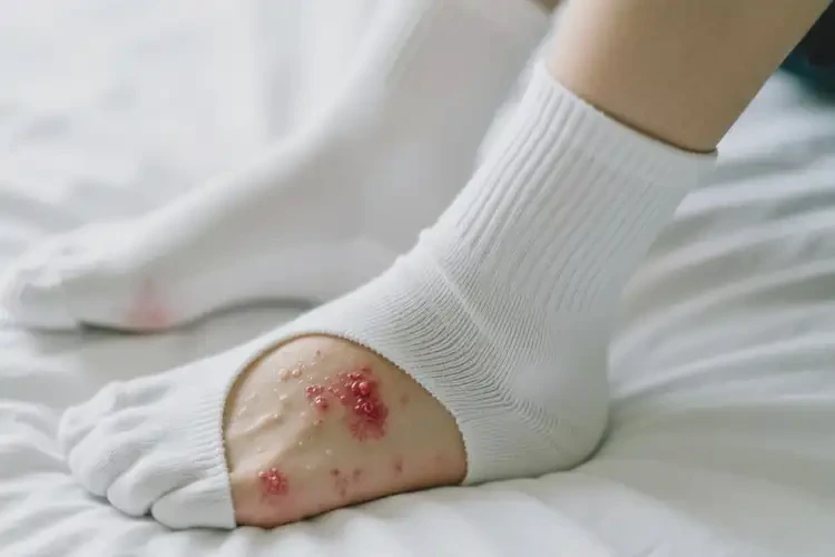 大学生脚上容易长湿疹不管它会自己好吗(图3)