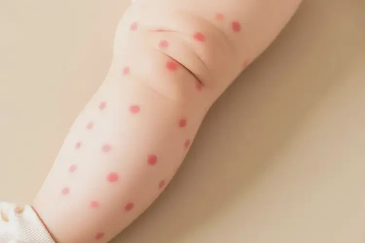 嬰幼兒小腿偶爾長濕疹不管它會自己自愈嗎(圖3)
