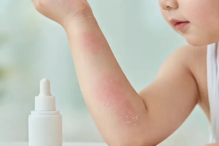 幼兒手臂偶爾起濕疹可以徹底自愈嗎(圖3)