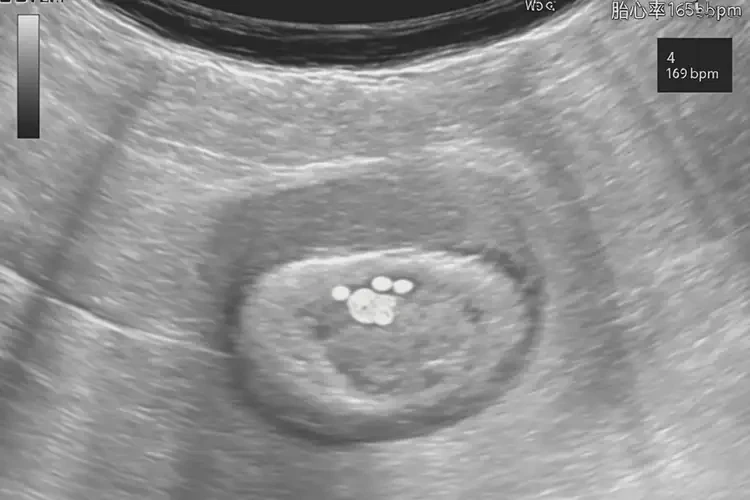 懷孕4周胎心率165怎么回事(圖4)