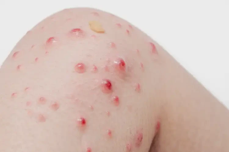 幼兒小腿上偶爾長(zhǎng)濕疹不管它會(huì)自己痊愈嗎(圖2)