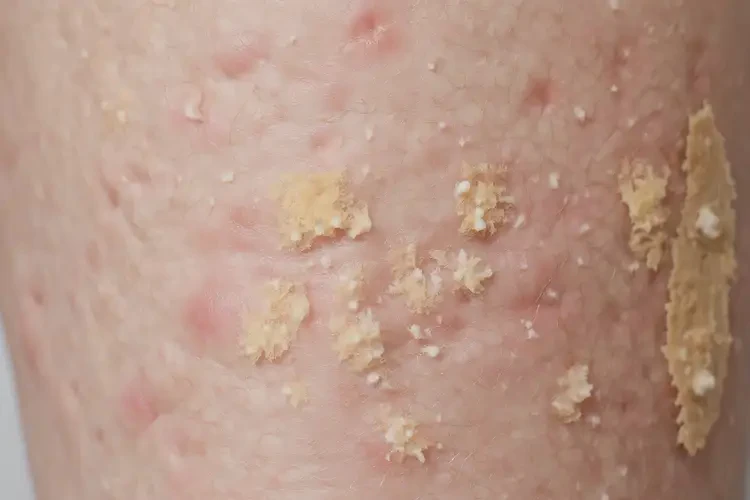 产妇小腿上出湿疹可不可以彻底自愈(图3)