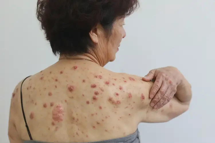 女性全身容易起濕疹能徹底自愈嗎(圖4)