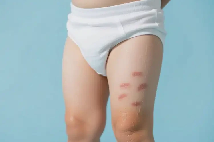 小孩大腿上容易長(zhǎng)濕疹不管它會(huì)自己自愈嗎(圖1)