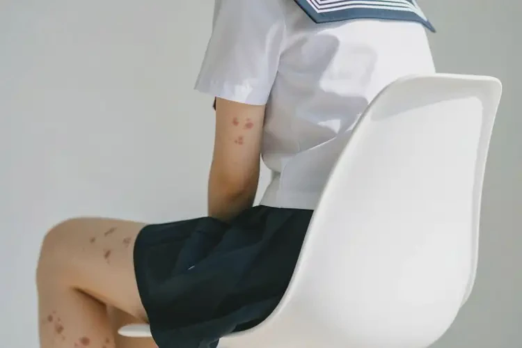 大學(xué)生屁股上經(jīng)常起濕疹能夠徹底治愈嗎(圖3)