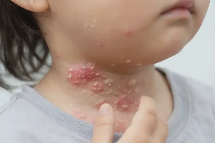 小兒脖子上起濕疹不管它會自己自愈嗎(圖4)