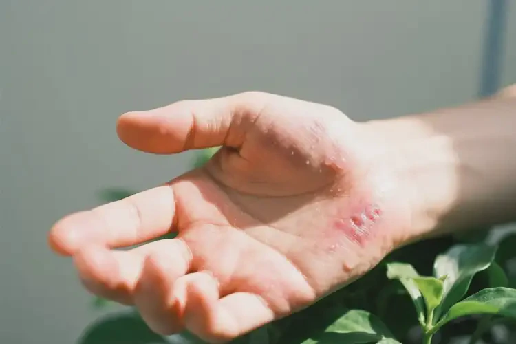 男生手上容易長濕疹能徹底自愈嗎(圖1)