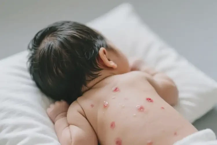 新生儿全身偶尔长湿疹可以彻底自愈吗(图2)