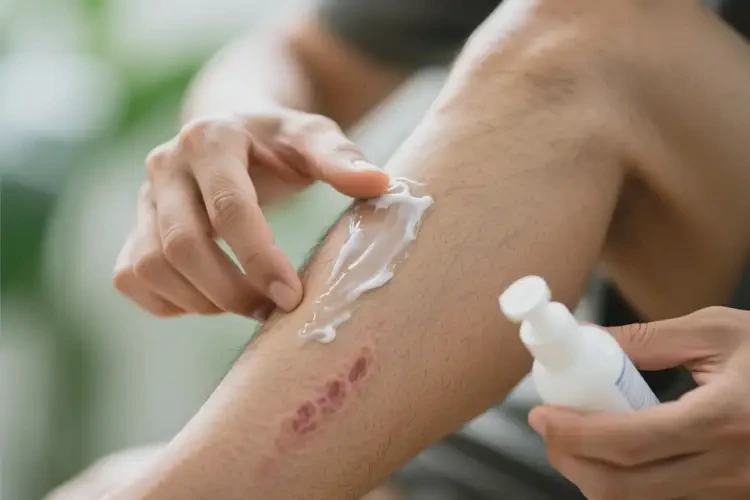 男人小腿上經(jīng)常長濕疹能不能徹底自愈(圖1)