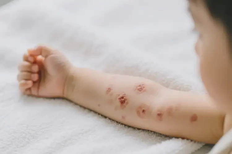 小孩手臂出濕疹不管它會自己痊愈嗎(圖2)
