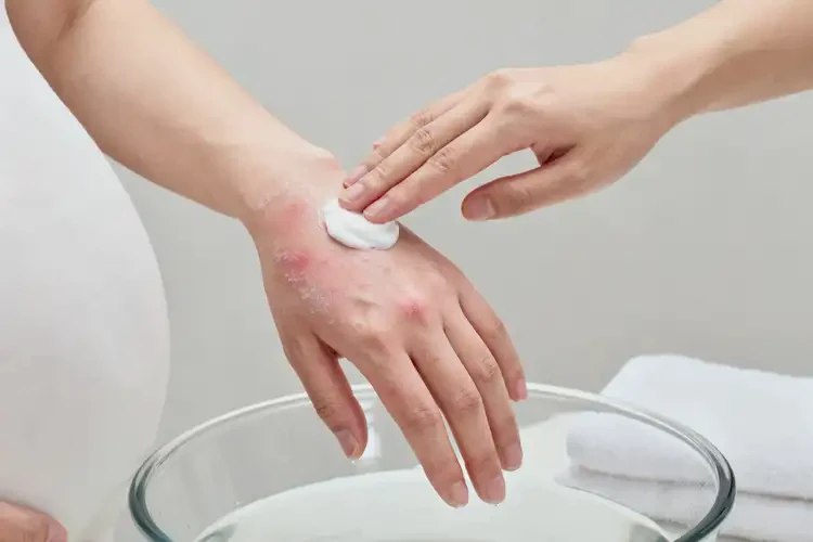 孕婦手上有濕疹不管它會(huì)自己好嗎(圖2)