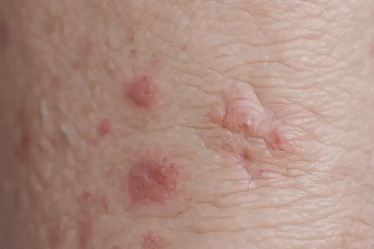 老年人小腿上出濕疹能夠徹底治愈嗎(圖4)