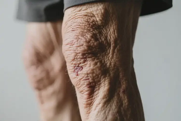 高齡老人大腿上出濕疹不管它會(huì)自己自愈嗎(圖2)