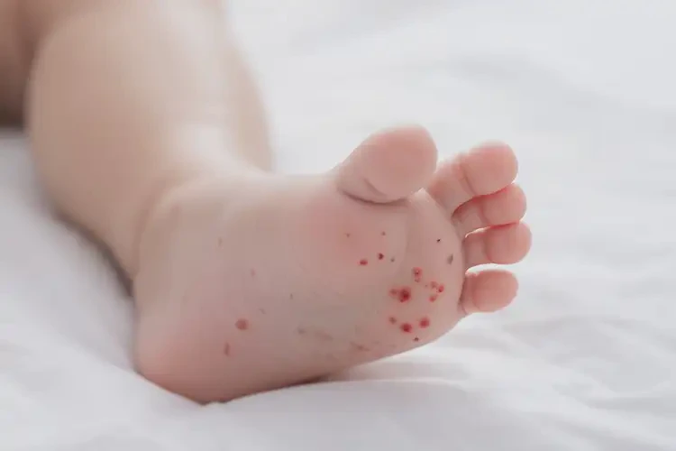 嬰幼兒腳上出現(xiàn)濕疹不管它會自己痊愈嗎(圖4)