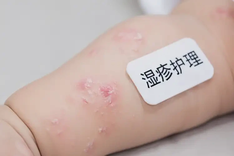 婴儿手臂偶尔起湿疹不管它会自己痊愈吗(图4)
