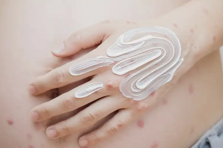 產(chǎn)婦手上偶爾起濕疹不管它會自己好嗎(圖2)