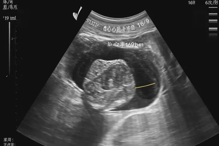 孕19周6天胎心率169還能保住嗎(圖4)