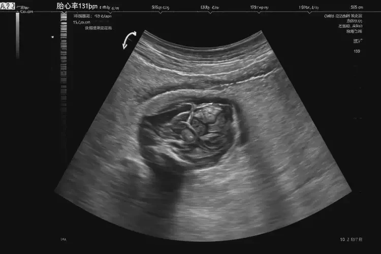 孕15周3天胎心131正常嗎(圖4)