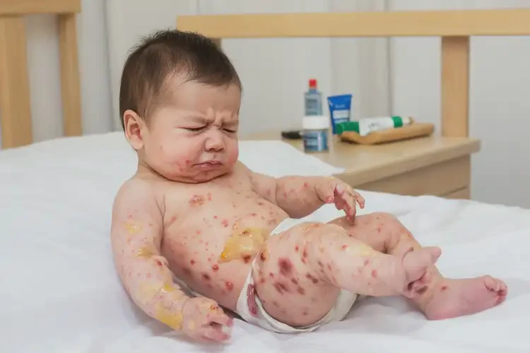 嬰兒全身偶爾長濕疹不管它會自己自愈嗎(圖3)