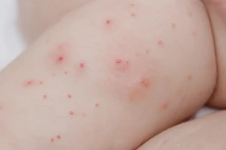 宝宝屁股经常起湿疹能靠自己自愈吗(图4)