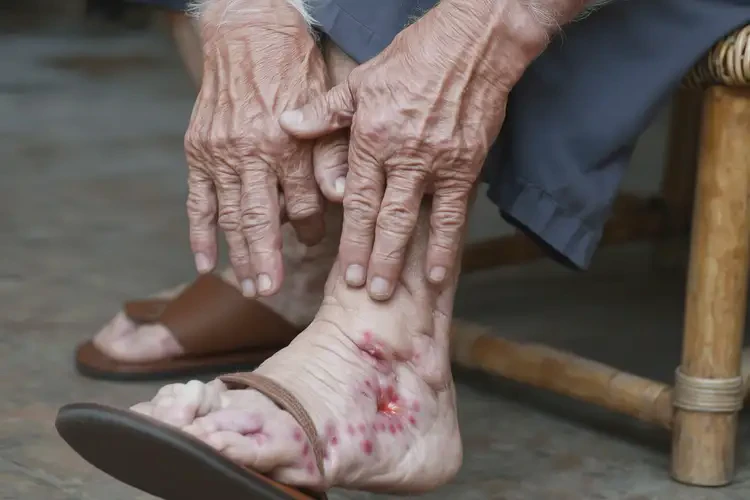 高齡老人腳上出濕疹不管它會自己痊愈嗎(圖4)