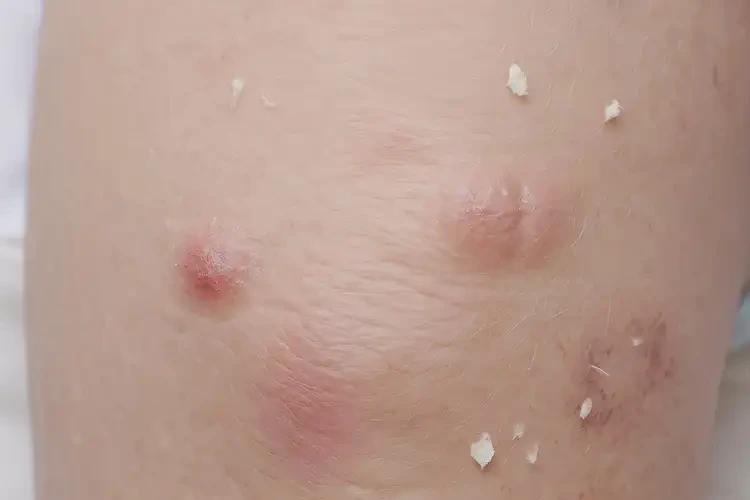 小學生小腿上經(jīng)常長濕疹能夠徹底治愈嗎(圖4)