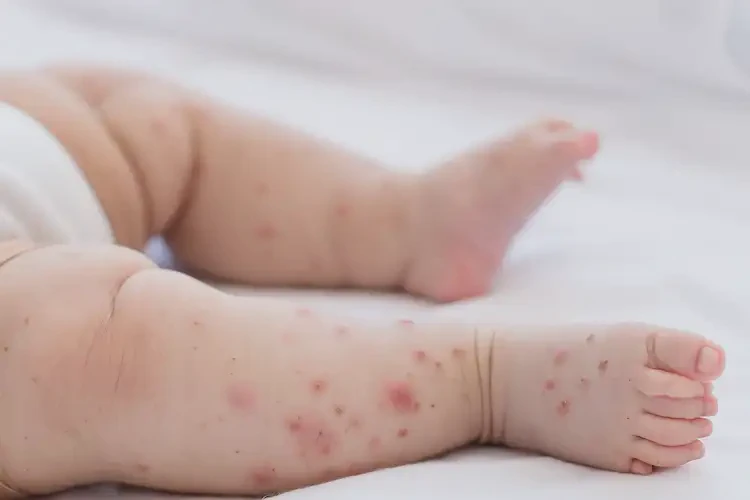 嬰兒四肢偶爾起濕疹不管它會(huì)自己自愈嗎(圖4)