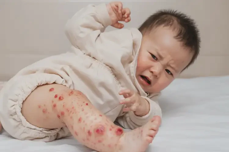嬰兒四肢偶爾起濕疹不管它會(huì)自己自愈嗎(圖2)