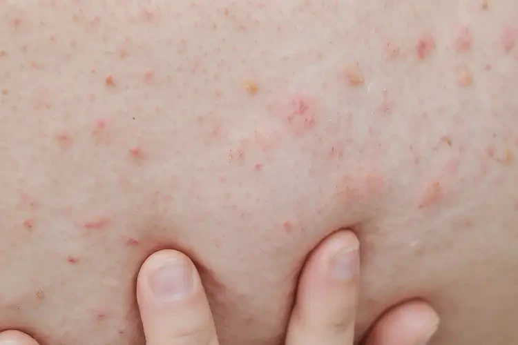 大學(xué)生小腿有濕疹不管它會自己自愈嗎(圖4)