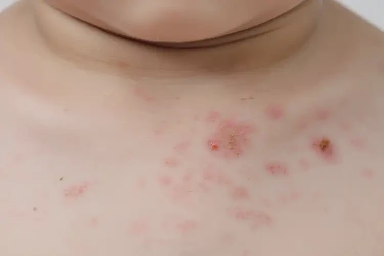 孩子脖子上起濕疹不管它會(huì)自己痊愈嗎(圖4)