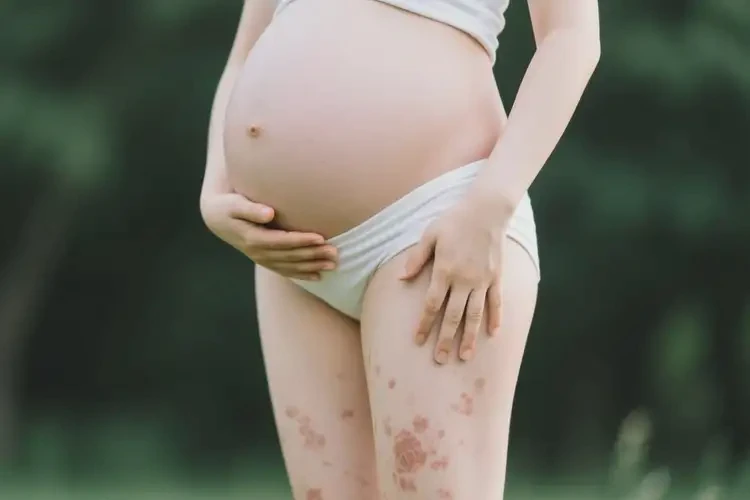 孕婦四肢偶爾長濕疹不管它會自己好嗎(圖2)