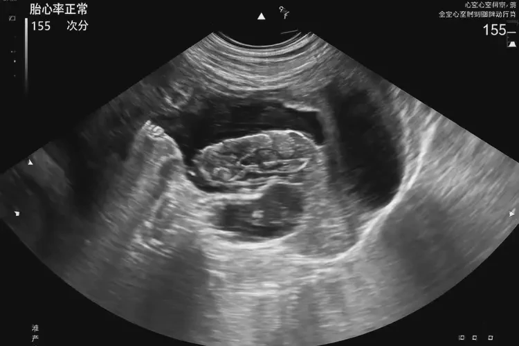 孕13周2天胎心100左右怎么回事(圖4)