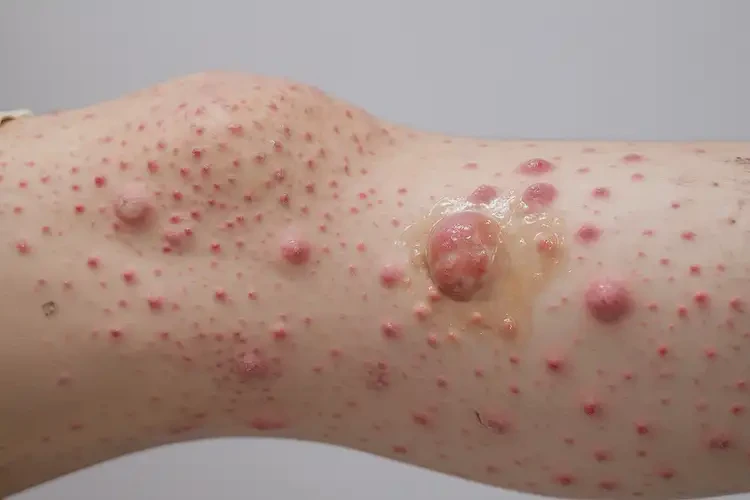 女性小腿上容易長濕疹不管它會自己痊愈嗎(圖3)