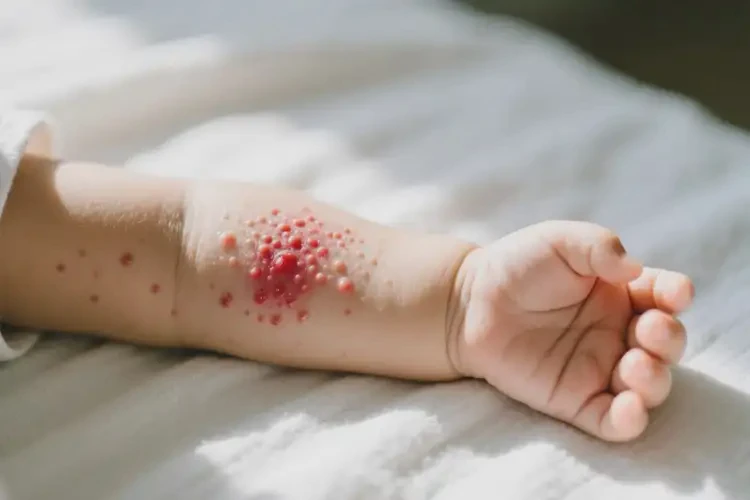 新生兒手臂上偶爾長濕疹可以徹底自愈嗎(圖1)