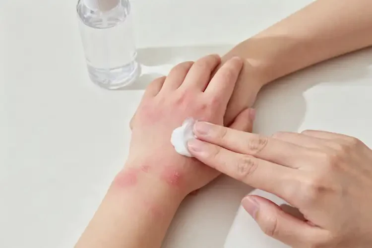 小孩手上有濕疹不管它會自己好嗎(圖1)