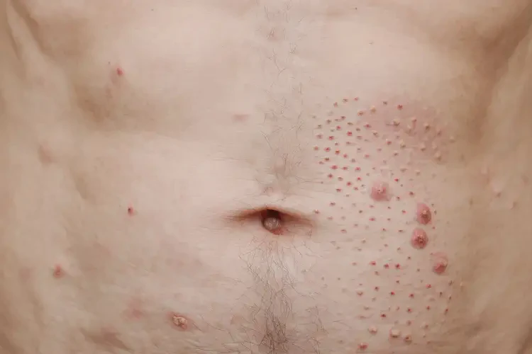 男生肚子上偶爾長濕疹不管它會自己自愈嗎(圖4)