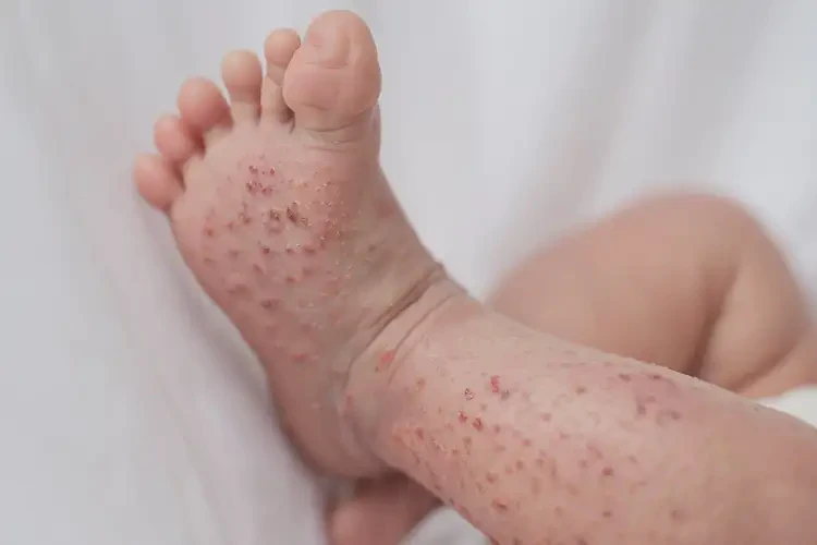 新生兒小腿上長濕疹能徹底自愈嗎(圖4)