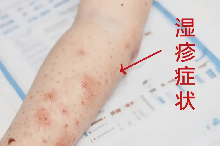 兒童身上有濕疹不管它會(huì)自己自愈嗎(圖4)