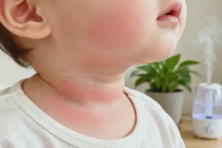 嬰幼兒脖子出濕疹可不可以徹底自愈(圖2)