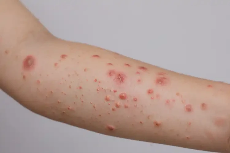 兒童手臂上起濕疹不管它會自己好嗎(圖4)